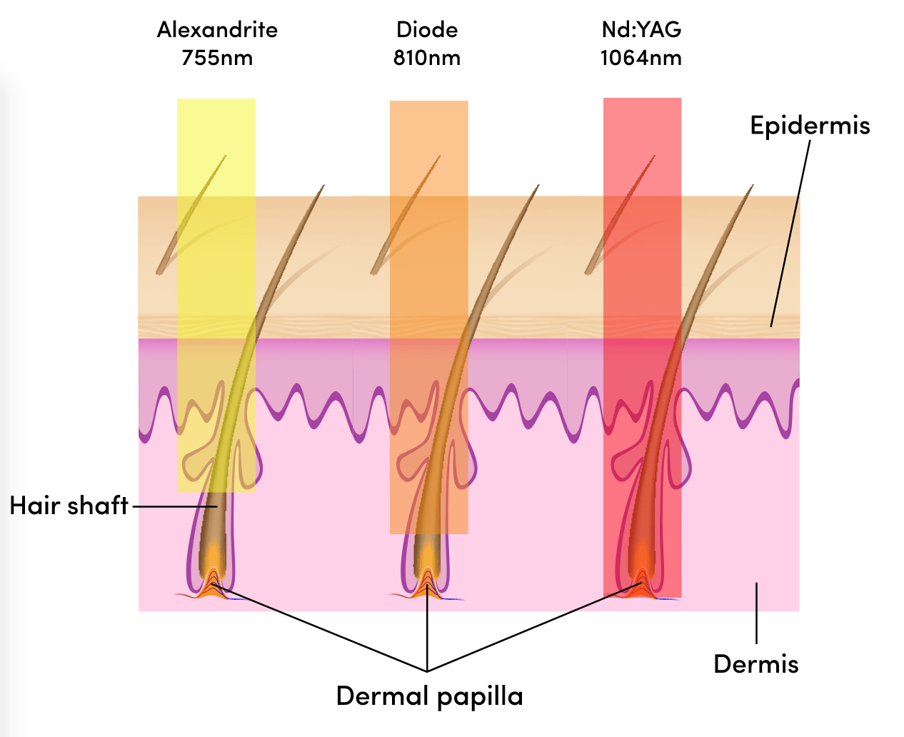 Laser technology for hair removal myLaser