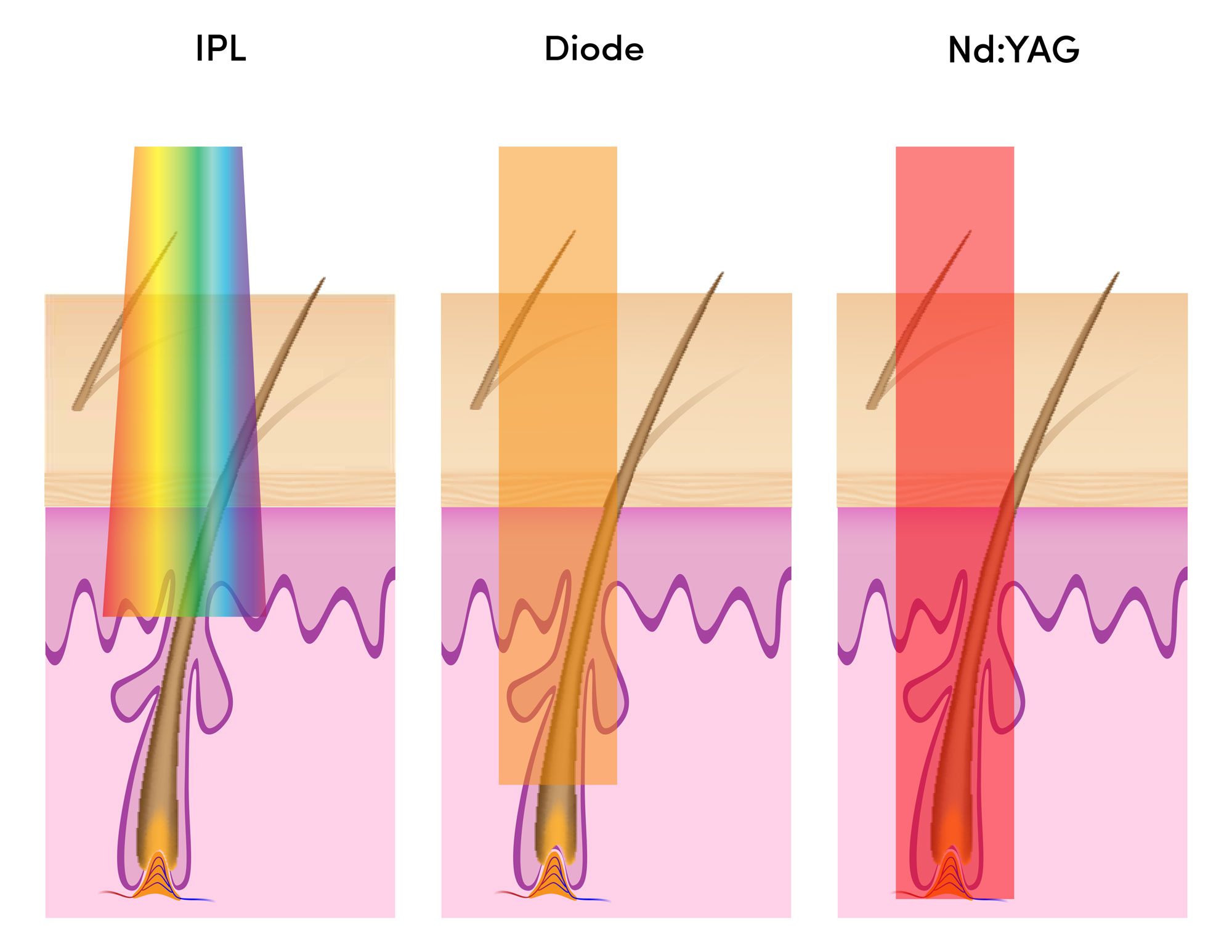 Laser hair reduction: triple vs single wavelength systems